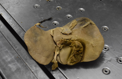 肝脏门静脉系统联合灌注标本的制作